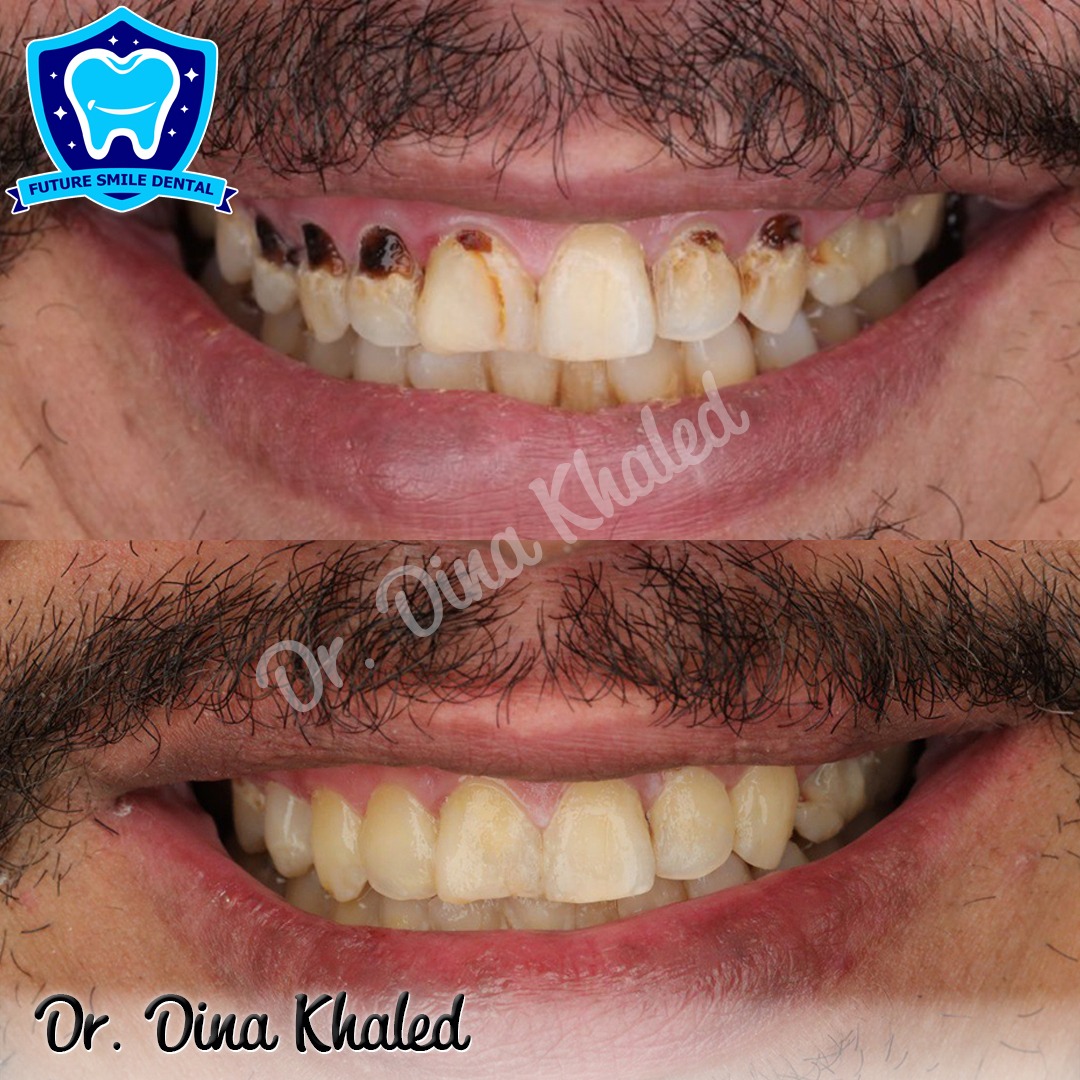 Dr. Dina Khaled — تأهيل كامل للفم